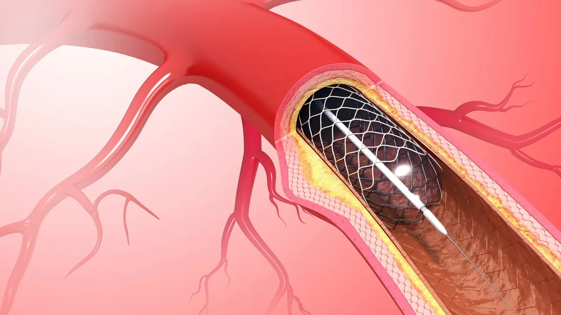 Angioplastia com Balão de Medicamento (DCB): 5 Vantagens no Tratamento da Doença Arterial