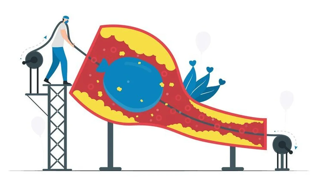 Entendendo o que é angioplastia de membros inferiores