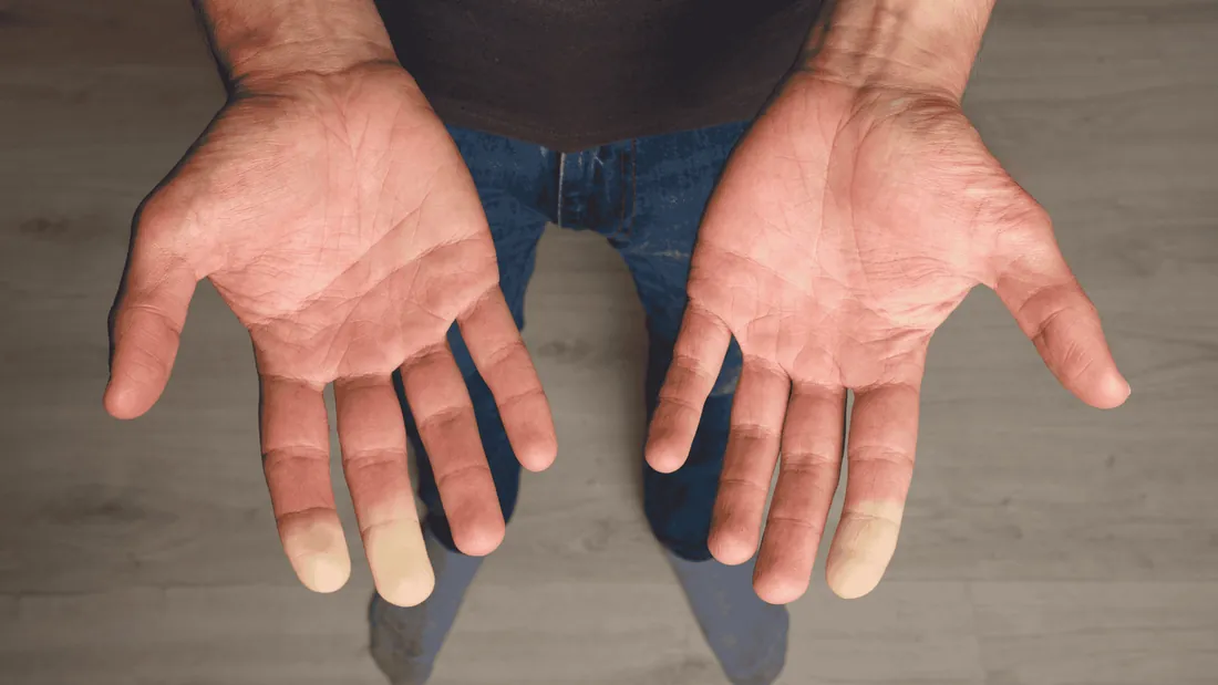 Doença de Raynaud: Diagnóstico e Proteção