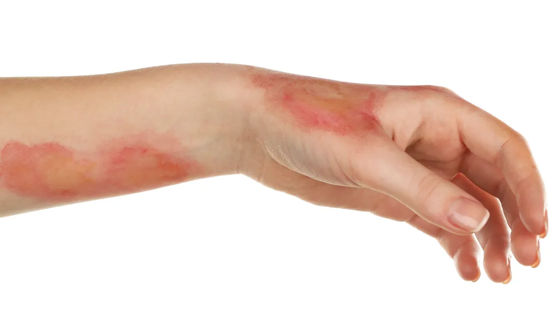 Eritromelalgia: 6 Causas, Sintomas e Tratamento das Mãos e Pés Vermelhos