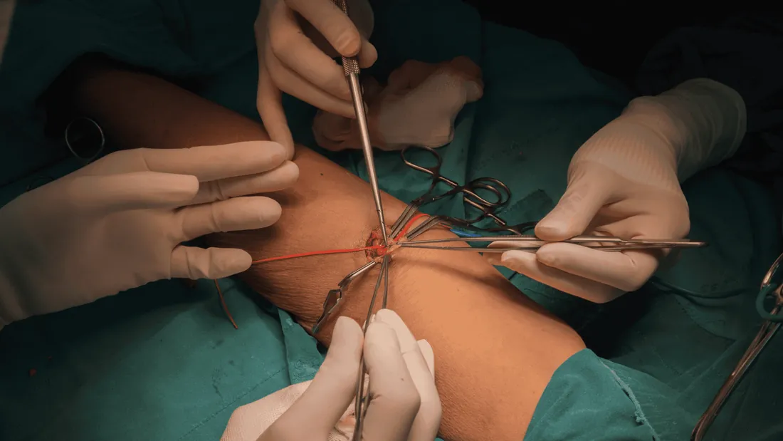 A Fístula Arteriovenosa (FAV): Criação e Manutenção do Acesso Vascular para Hemodiálise