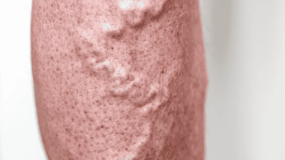 Flebite e Tromboflebite Superficial