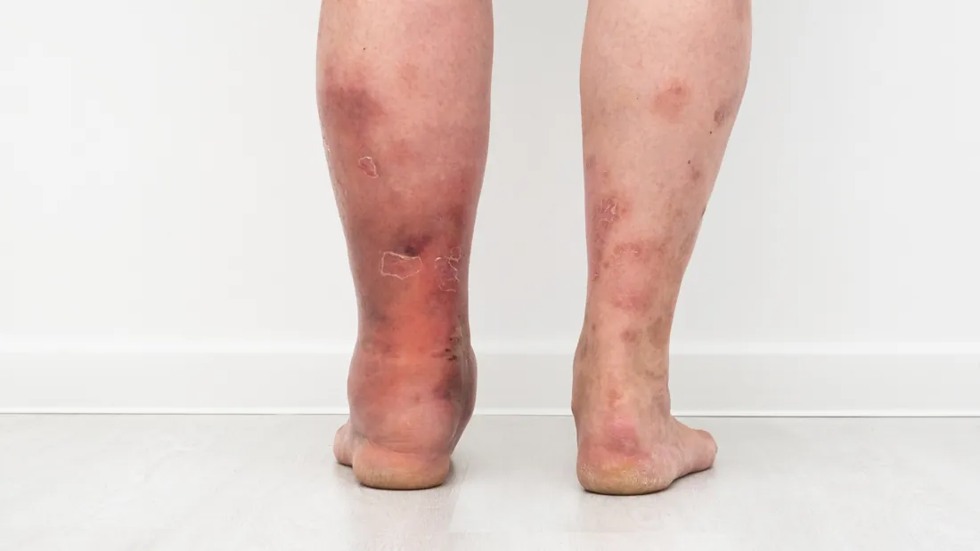 Linfangite: 7 Sinais da Inflamação dos Vasos Linfáticos