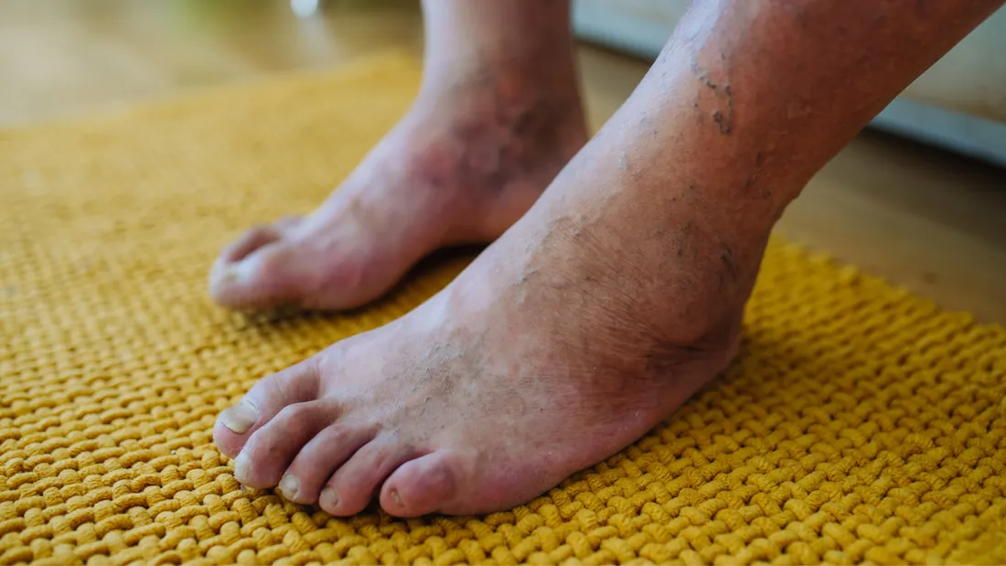 Pé Diabético: 7 Sinais de Isquemia e o Papel do Cirurgião Vascular no Salvamento do Membro