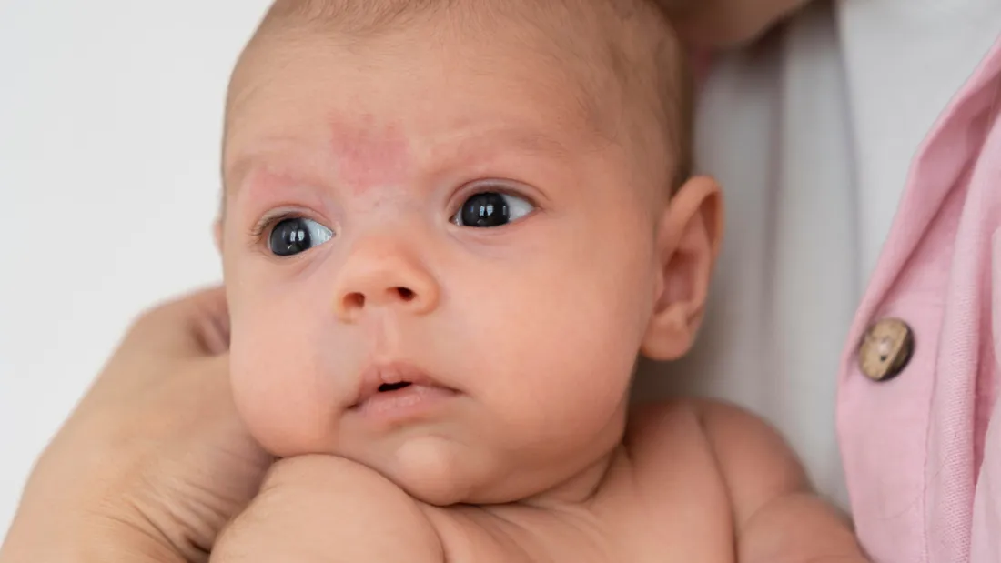 Síndrome de Klippel-Trénaunay: 5 Características da Malformação Vascular Congênita
