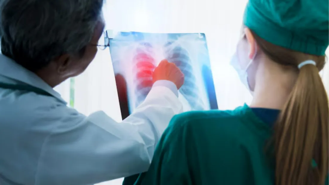 Tromboembolismo pulmonar: qual a relação com a trombose e como prevenir