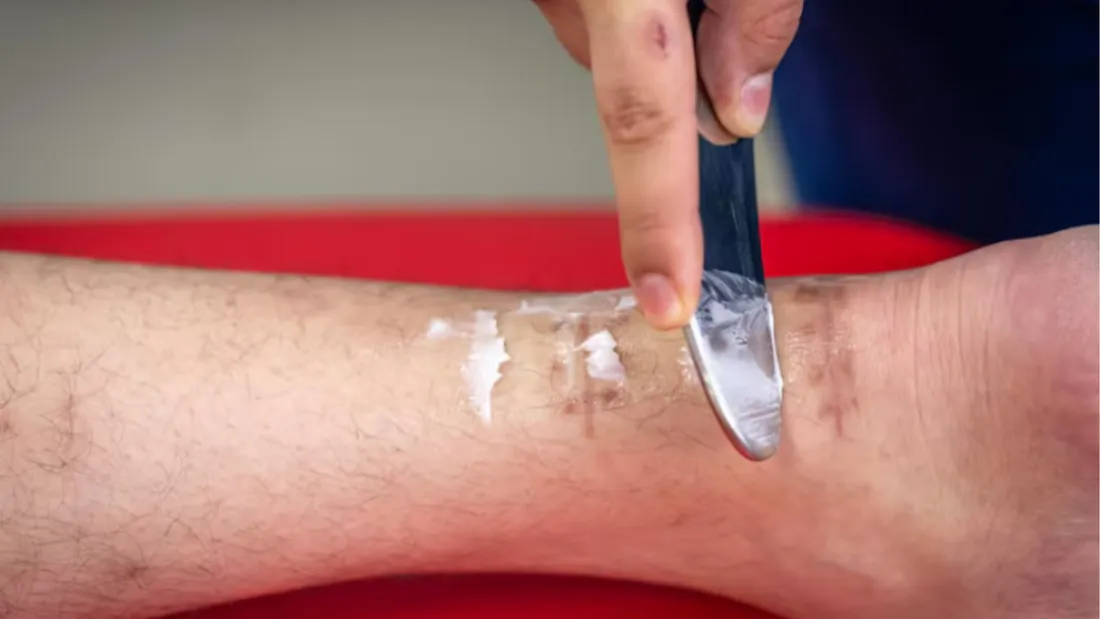 Úlceras varicosas: por que surgem e como é feito o tratamento vascular adequado